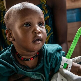Nyawud Keak (7 months old) gets her id-upper arm circumference taken at Juba IDP camp nutrition center.